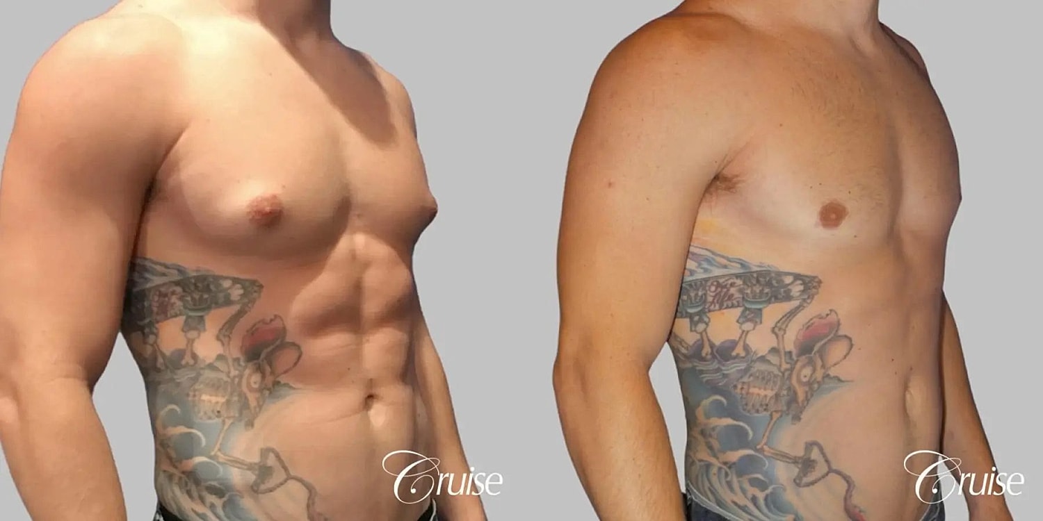 Gynecomastia Surgery Before & After