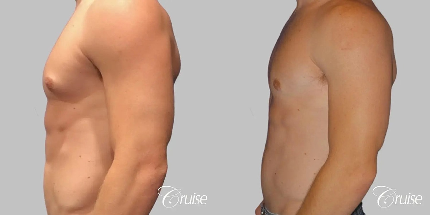 Gynecomastia Surgery Before & After