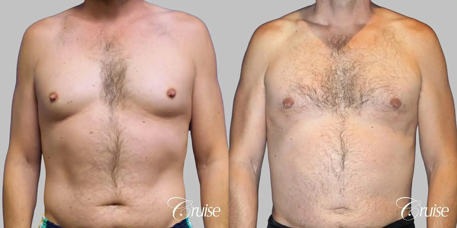 Gynecomastia Surgery Before & After