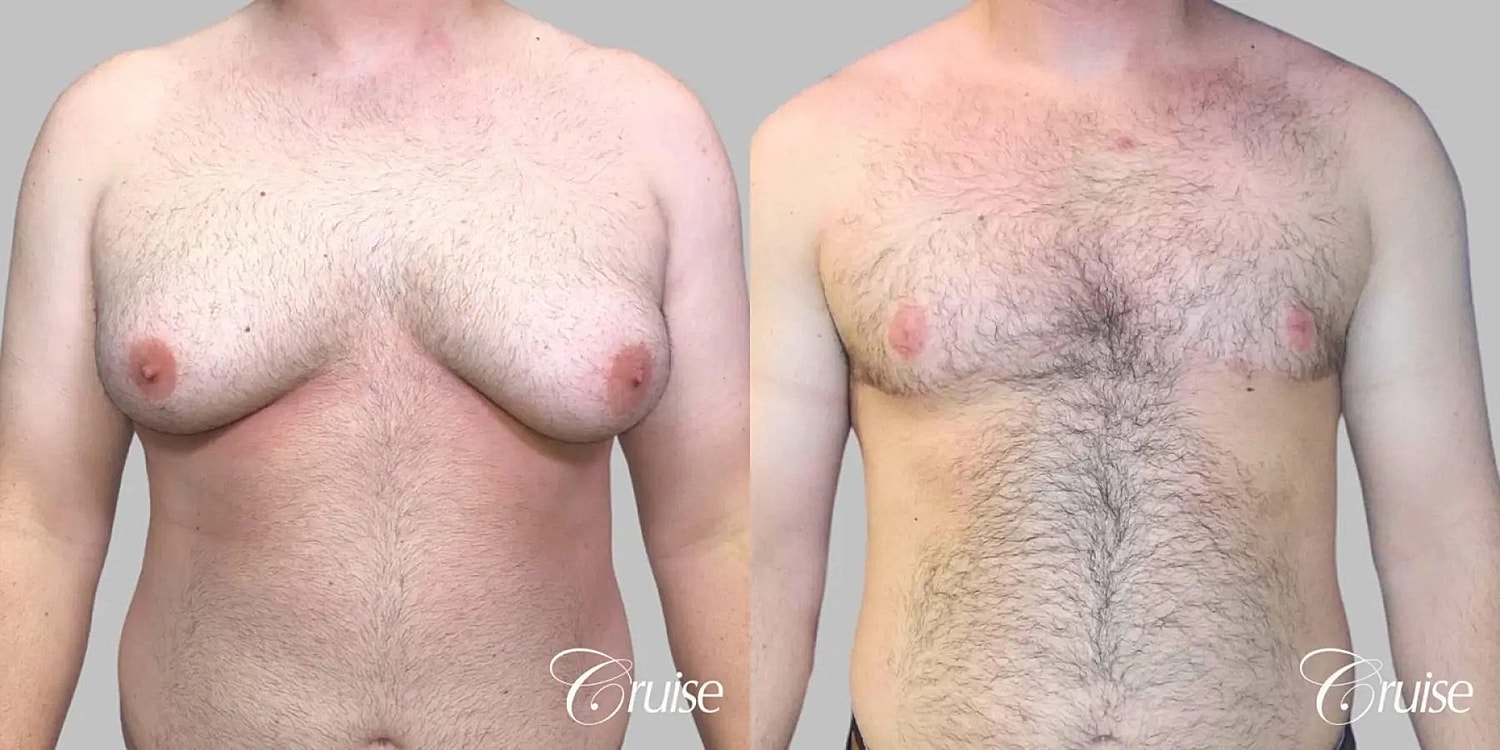Gynecomastia Surgery Before & After