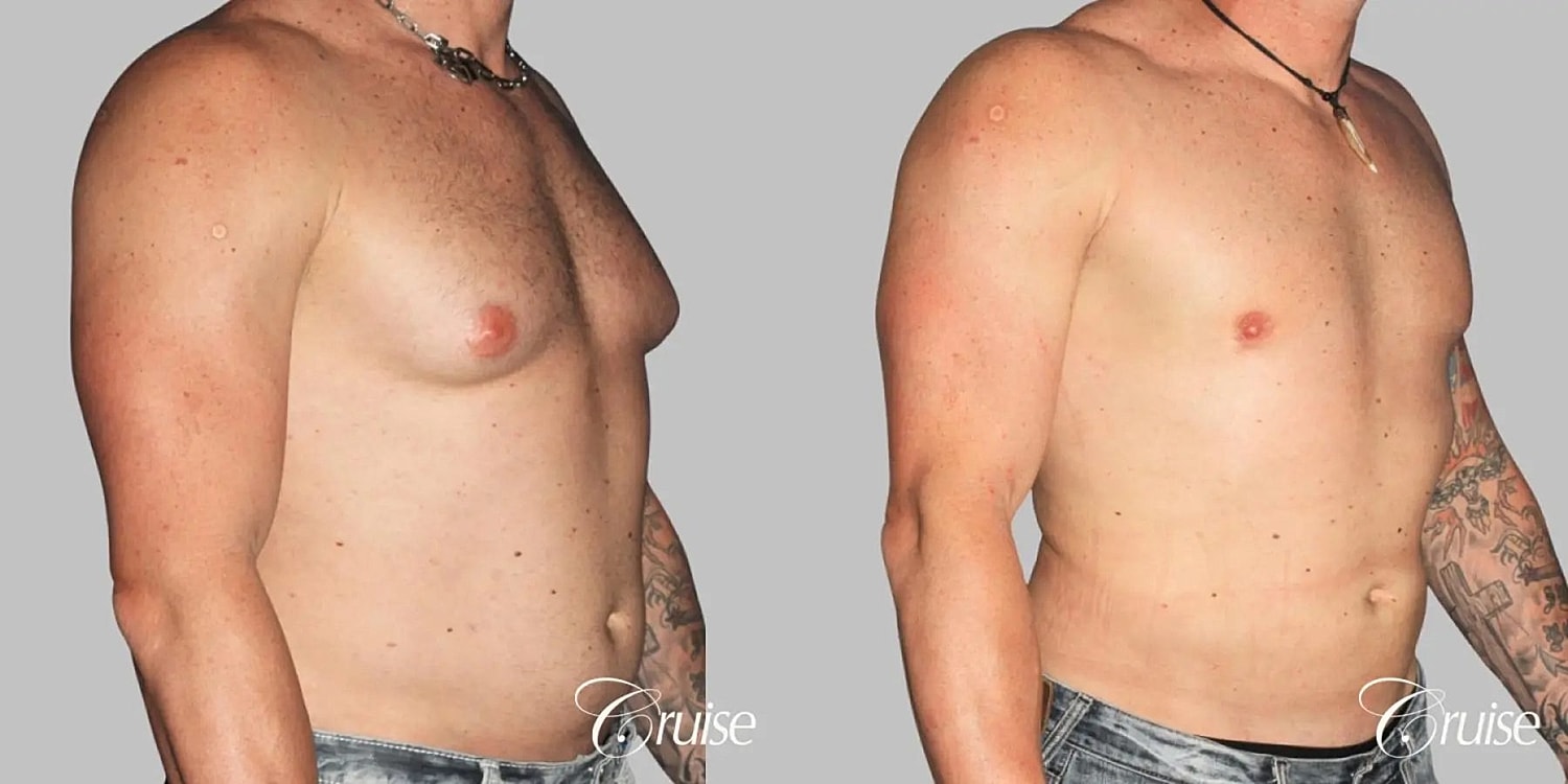 Gynecomastia Surgery Before & After