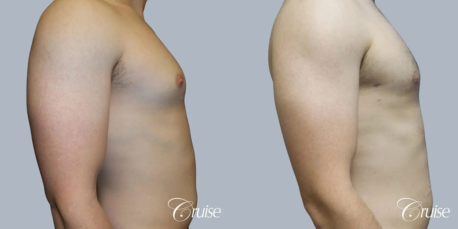 Gynecomastia Surgery Before & After