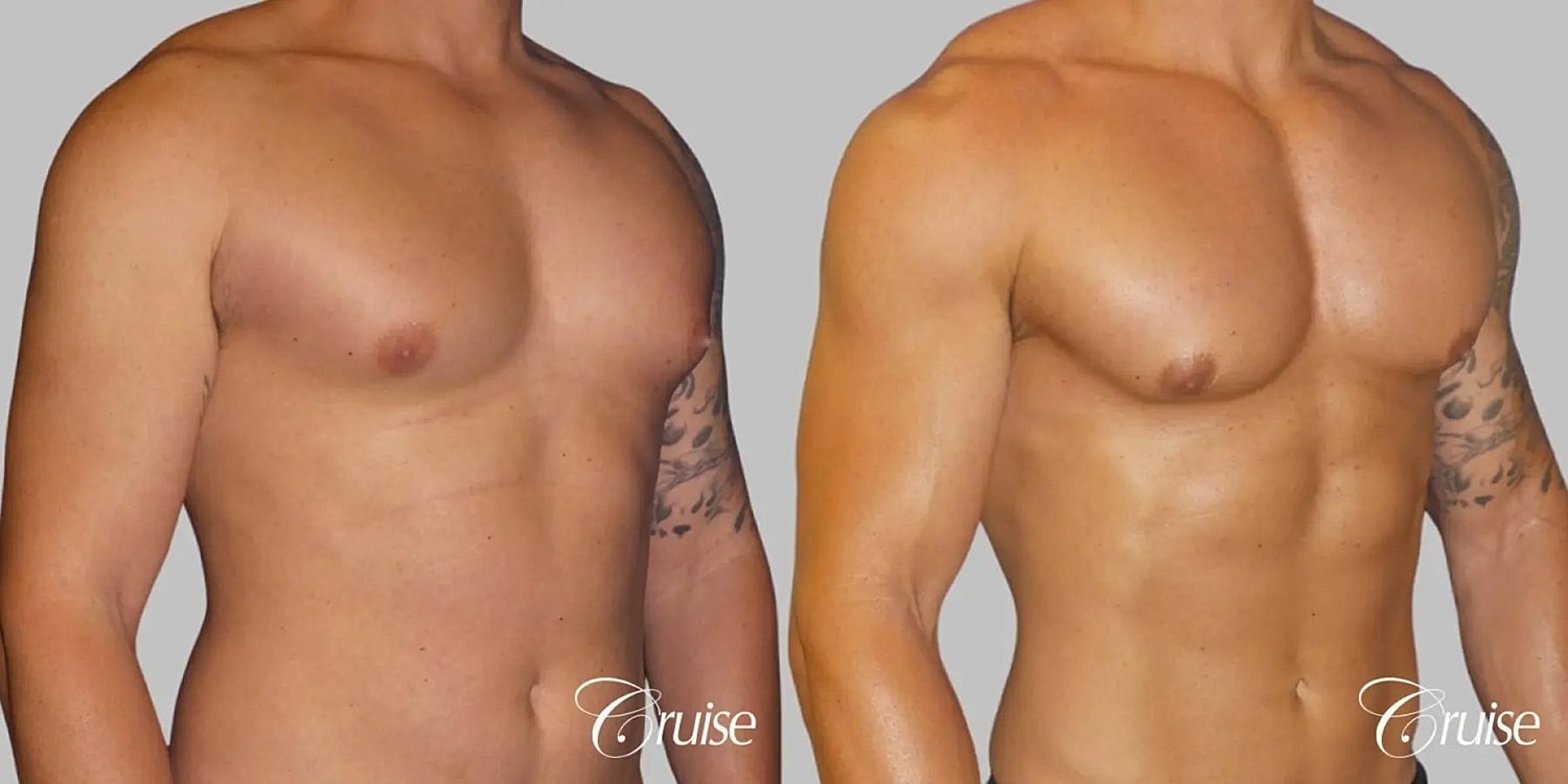Gynecomastia Surgery Before & After