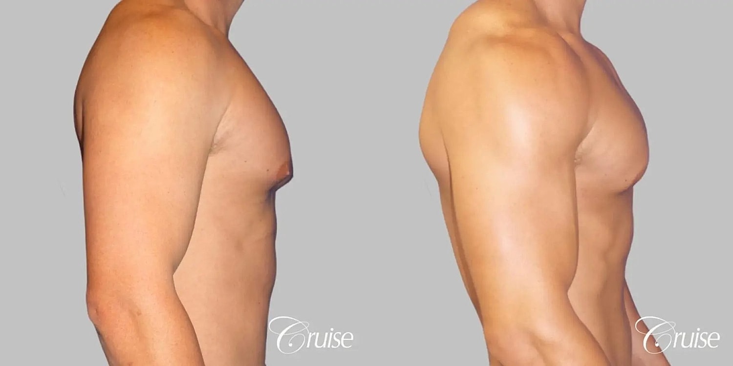 Gynecomastia Surgery Before & After