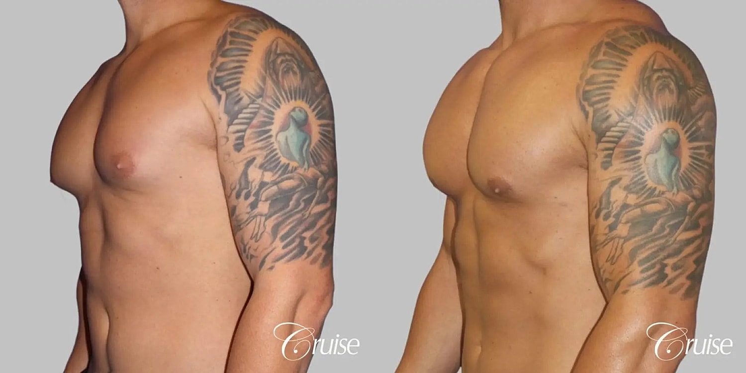 Gynecomastia Surgery Before & After