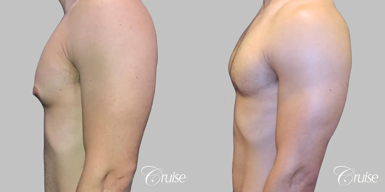 Gynecomastia Surgery Before & After