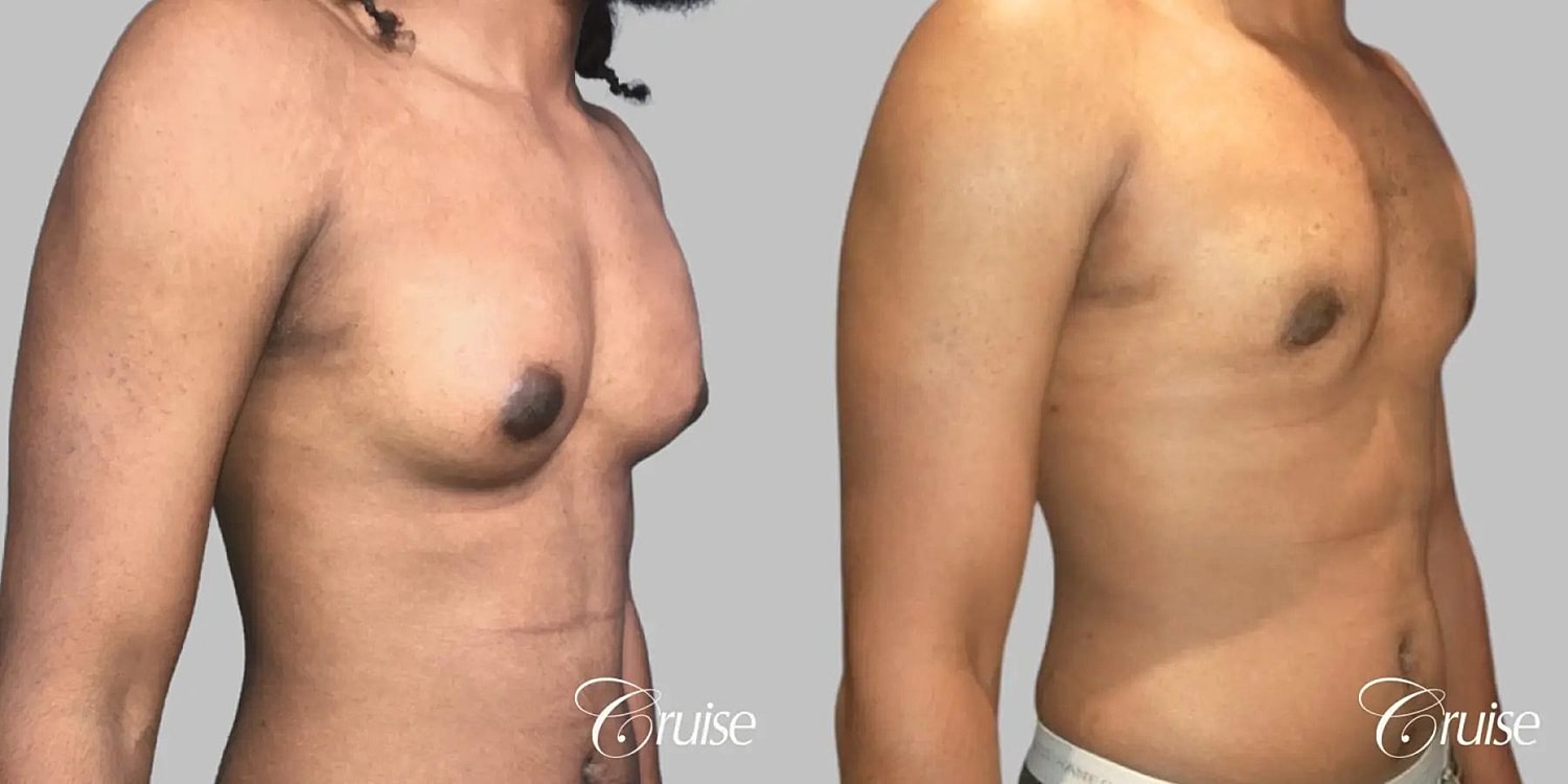 Gynecomastia Surgery Before & After