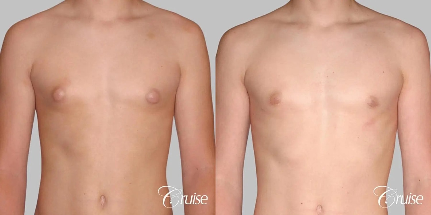 Gynecomastia Surgery Before & After