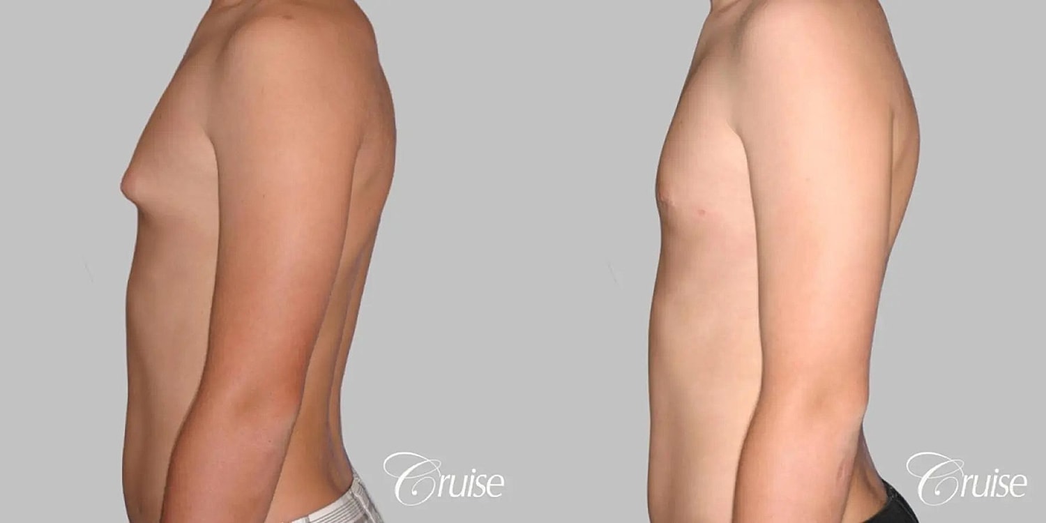 Gynecomastia Surgery Before & After