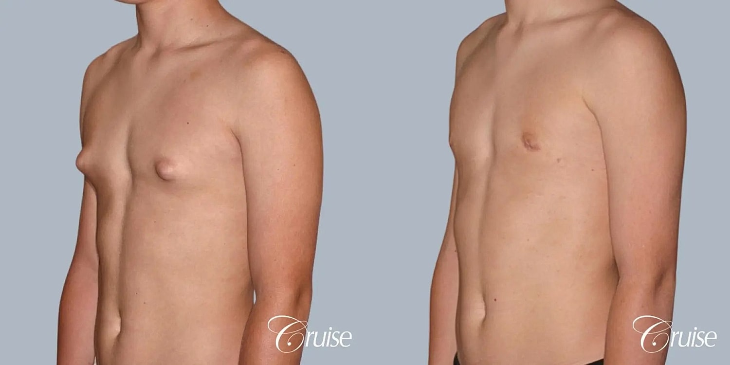 Gynecomastia Surgery Before & After