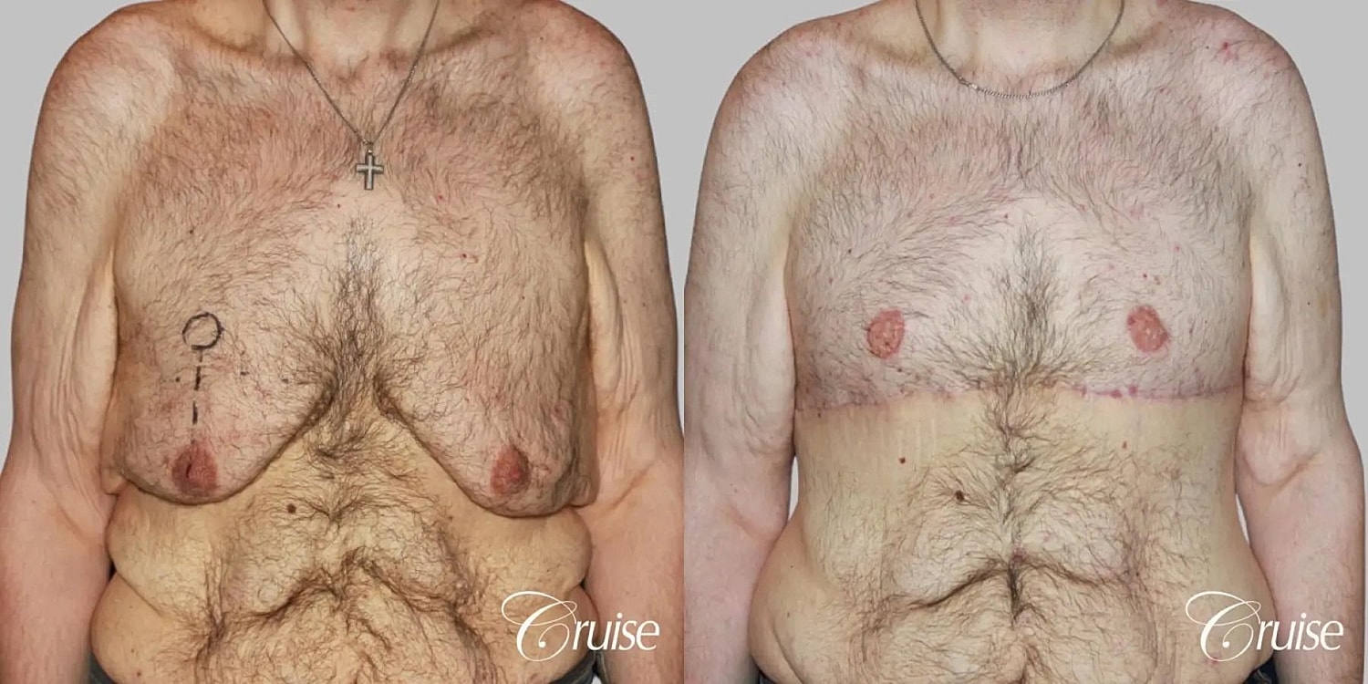 Gynecomastia Surgery Before & After