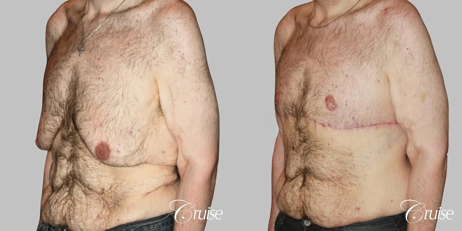Gynecomastia Surgery Before & After