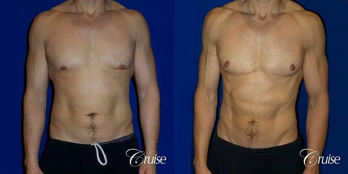 Gynecomastia Surgery Before & After