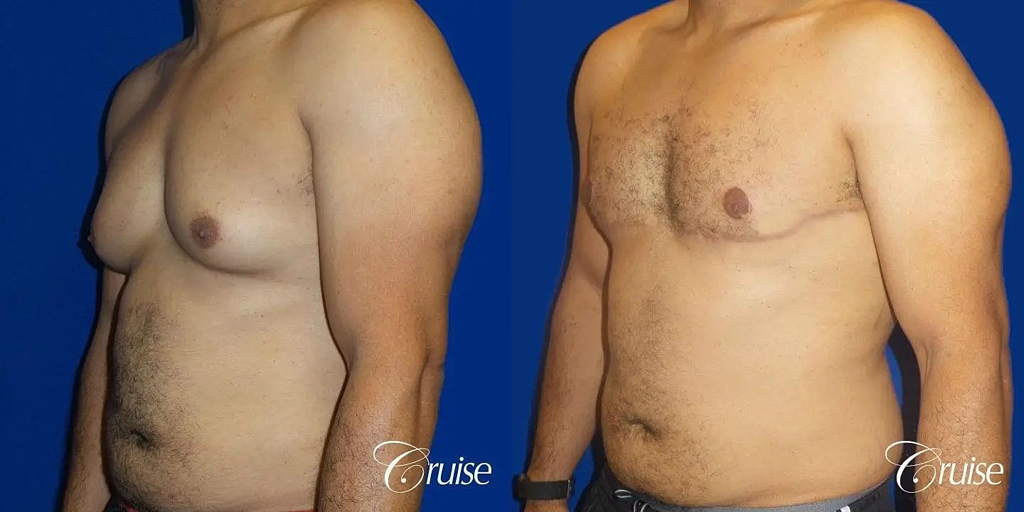 Gynecomastia Surgery Before & After
