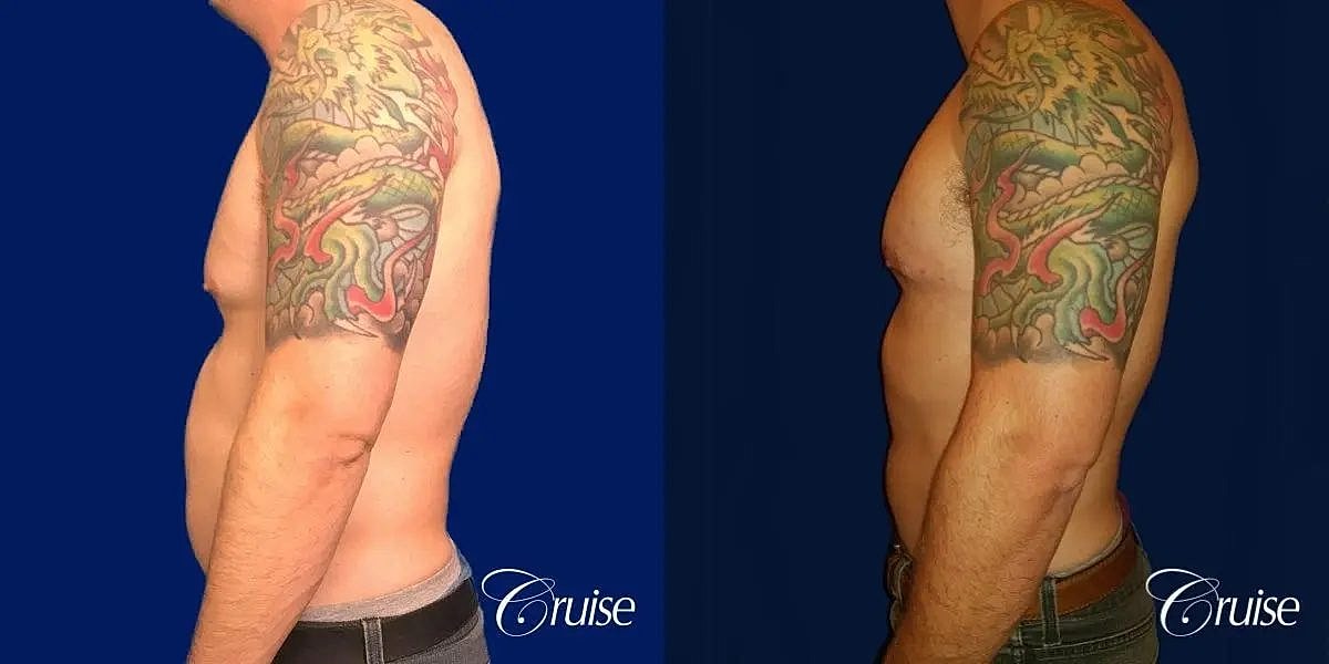 Gynecomastia Surgery Before & After