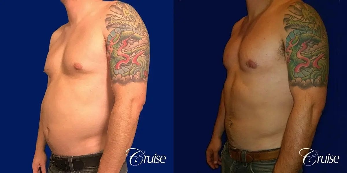 Gynecomastia Surgery Before & After