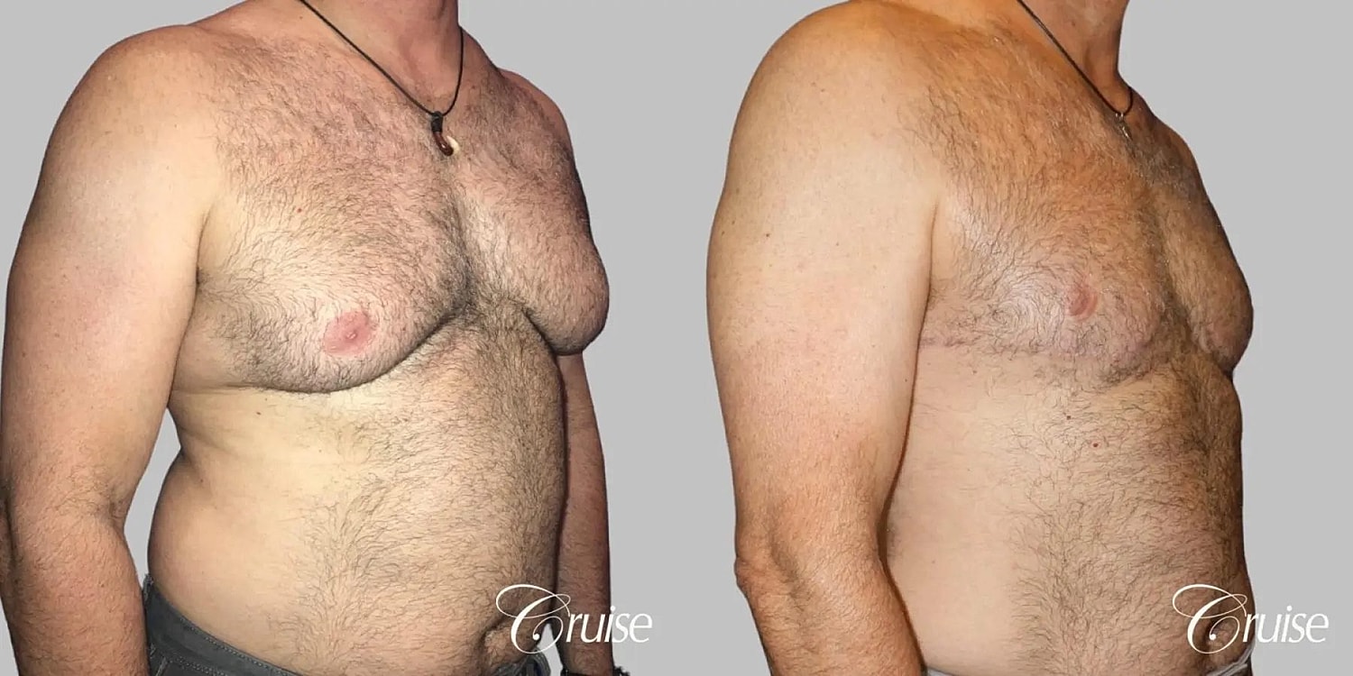Gynecomastia Surgery Before & After