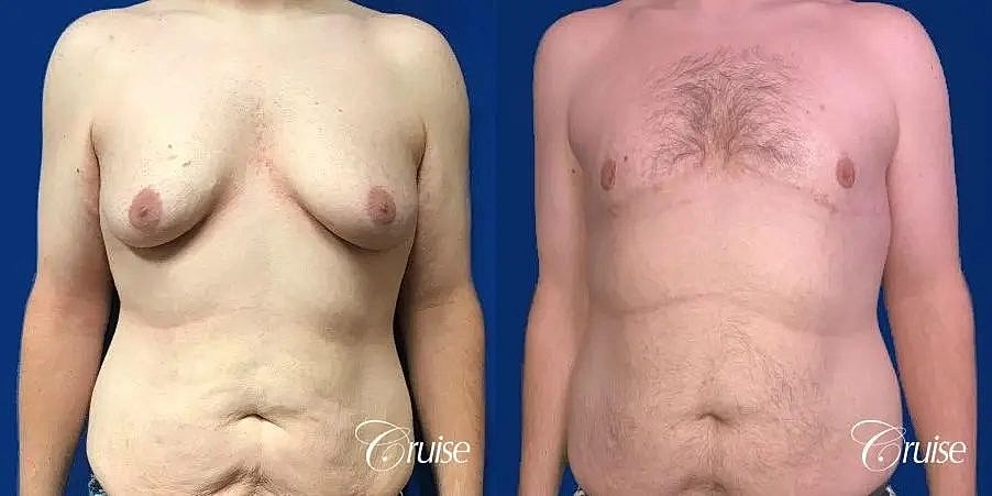 Gynecomastia Surgery Before & After