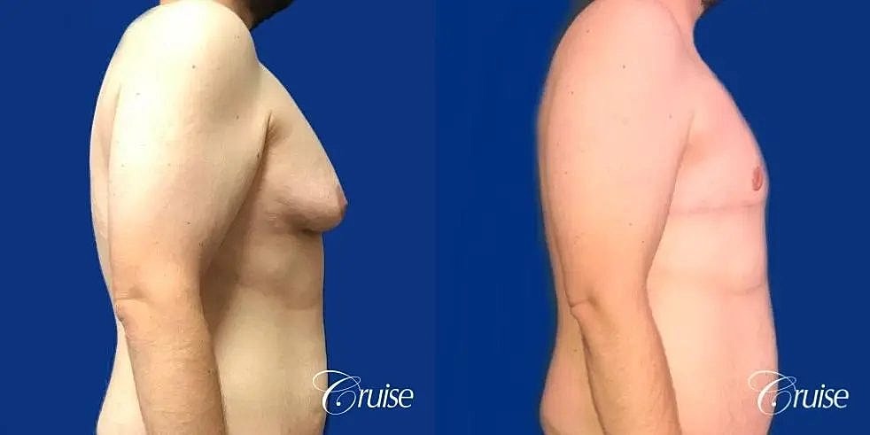 Gynecomastia Surgery Before & After