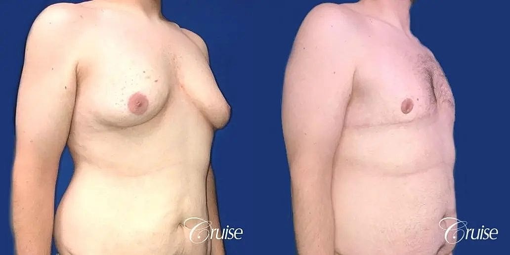 Gynecomastia Surgery Before & After