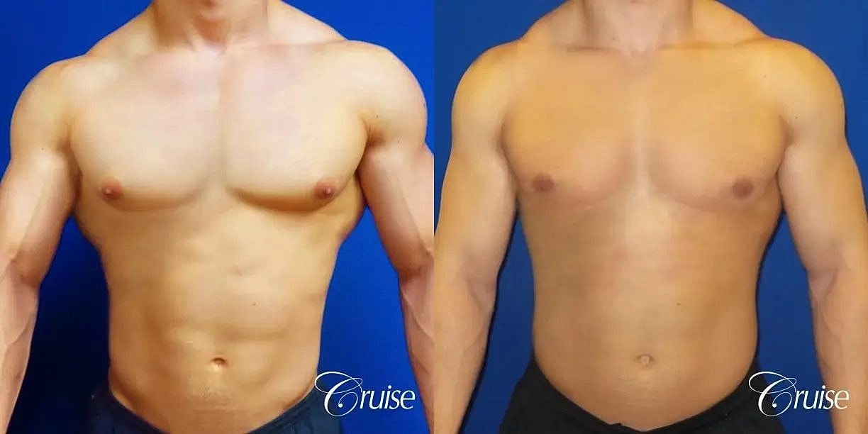 Gynecomastia Surgery Before & After