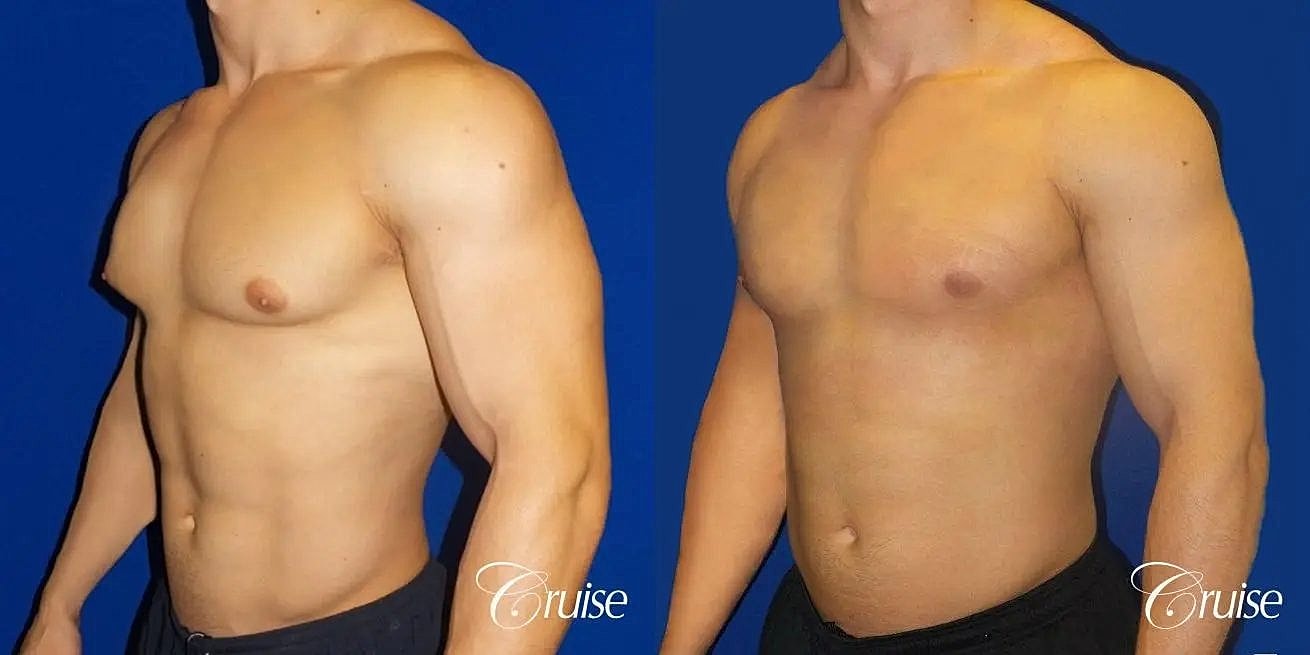 Gynecomastia Surgery Before & After