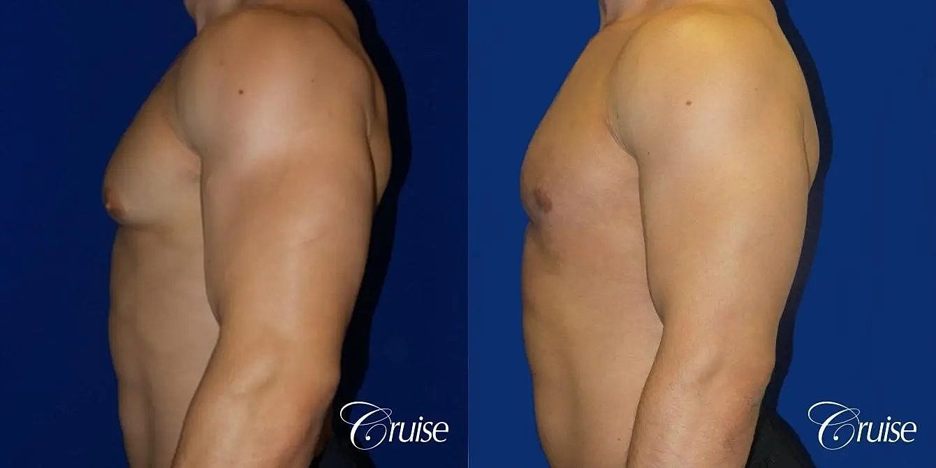 Gynecomastia Surgery Before & After