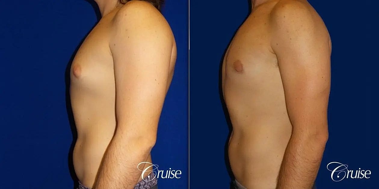 Gynecomastia Surgery Before & After