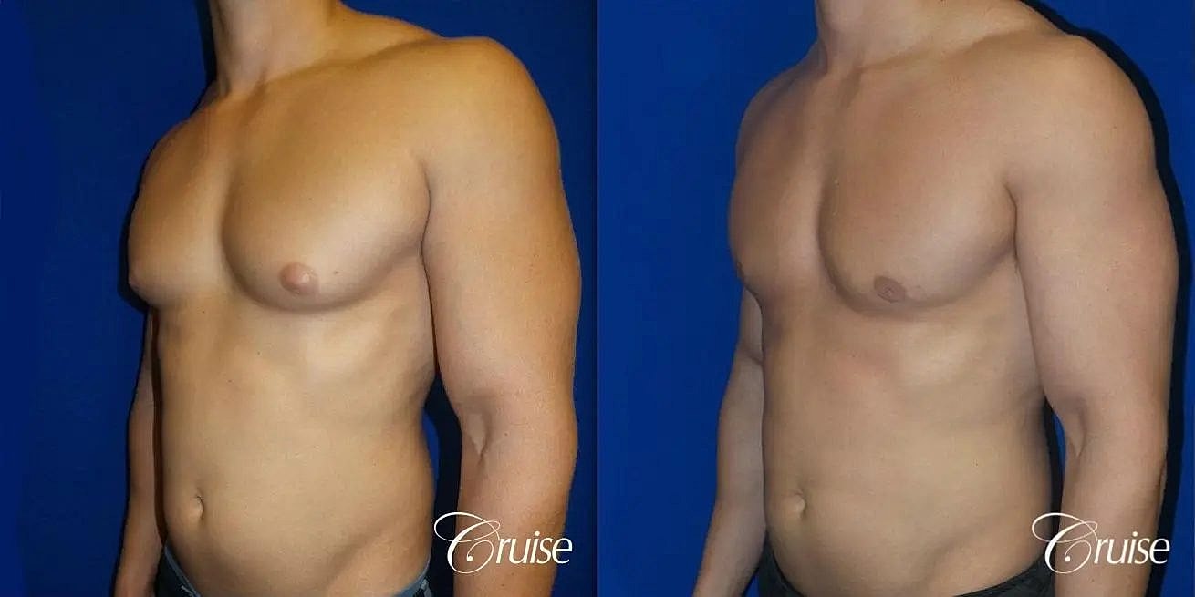 Gynecomastia Surgery Before & After