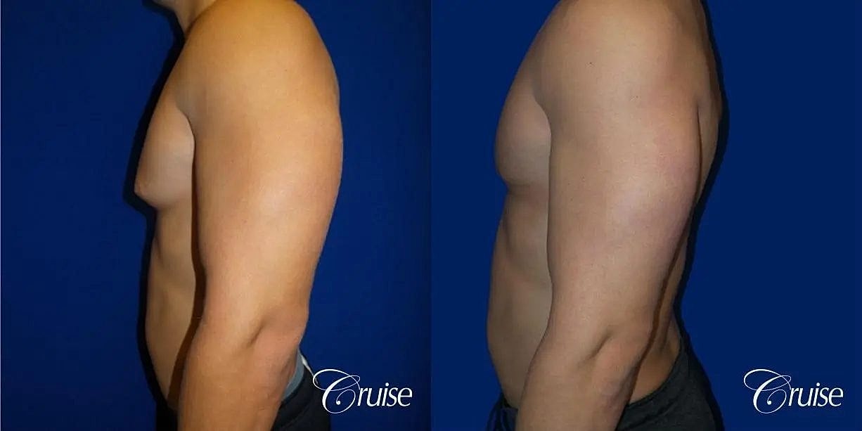 Gynecomastia Surgery Before & After