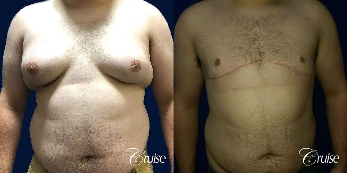 Gynecomastia Surgery Before & After