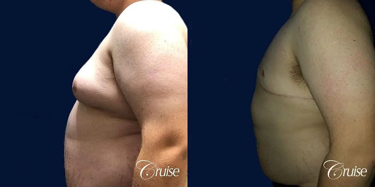 Gynecomastia Surgery Before & After