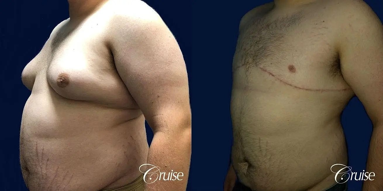 Gynecomastia Surgery Before & After