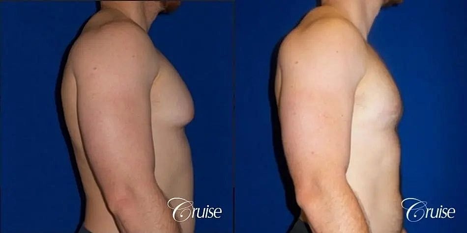 Gynecomastia Surgery Before & After