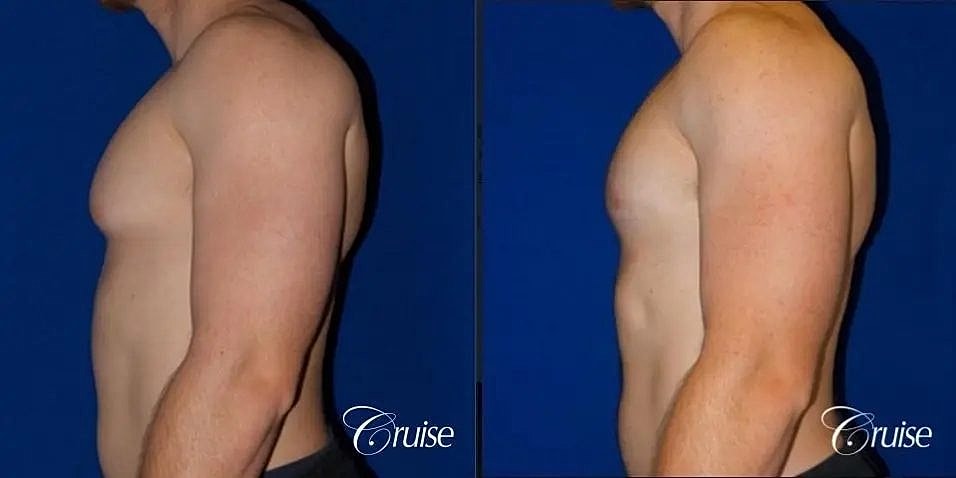 Gynecomastia Surgery Before & After