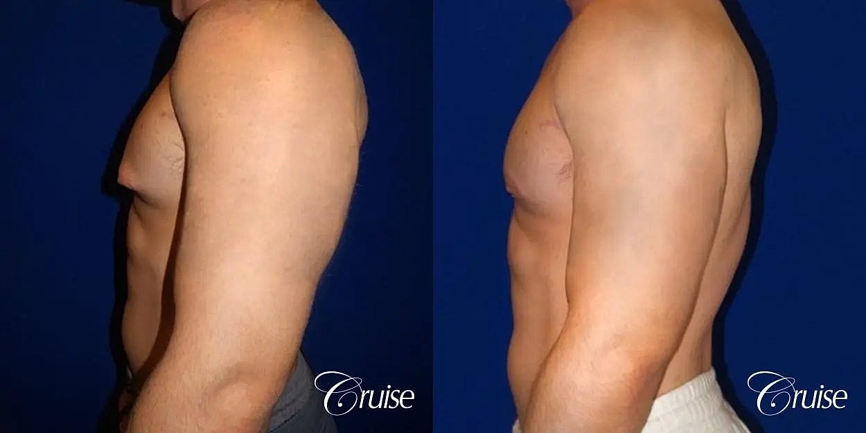 Gynecomastia Surgery Before & After