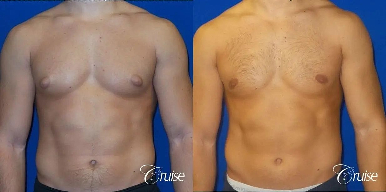 Gynecomastia Surgery Before & After