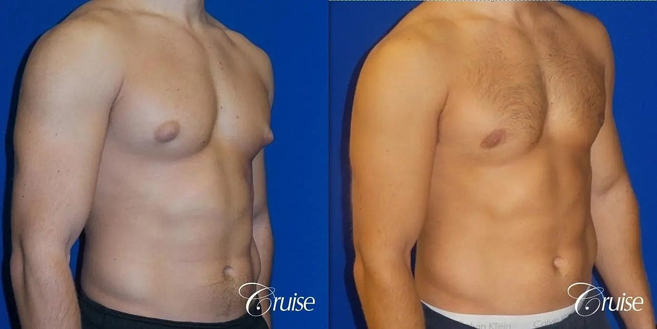 Gynecomastia Surgery Before & After