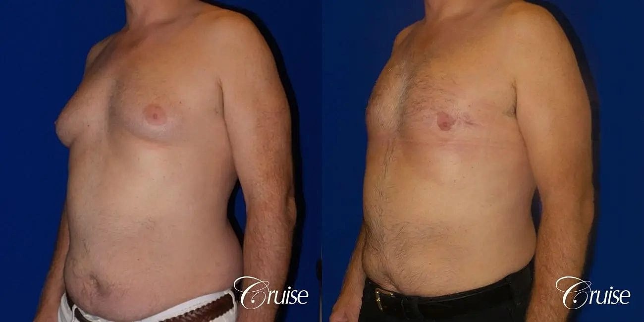Gynecomastia Surgery Before & After