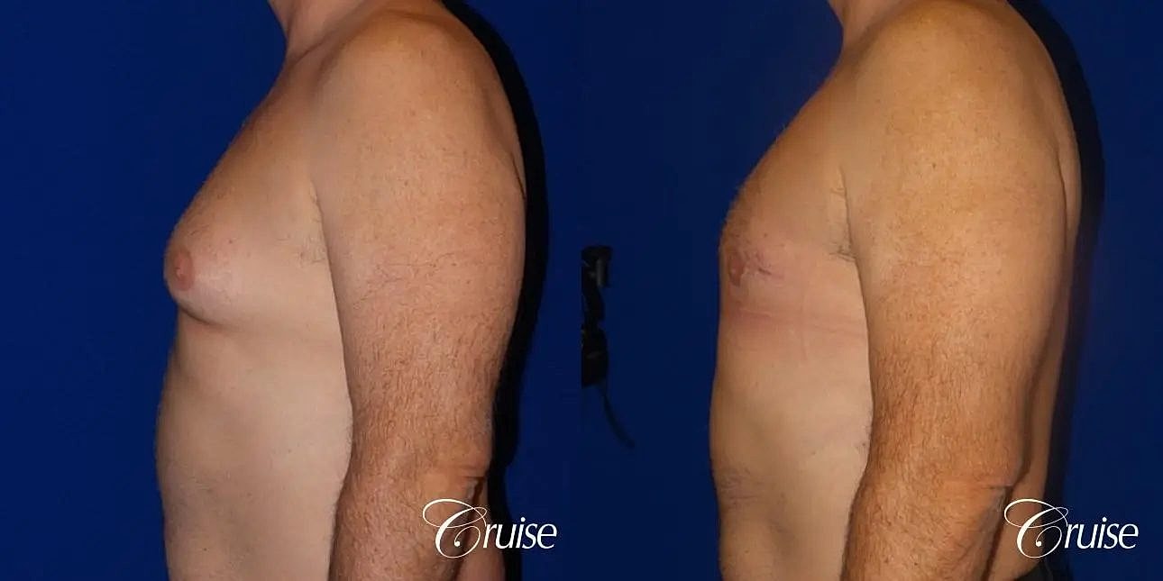 Gynecomastia Surgery Before & After