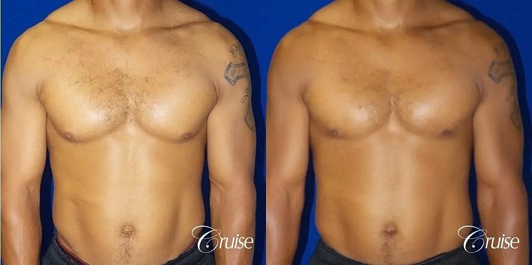 Gynecomastia Surgery Before & After