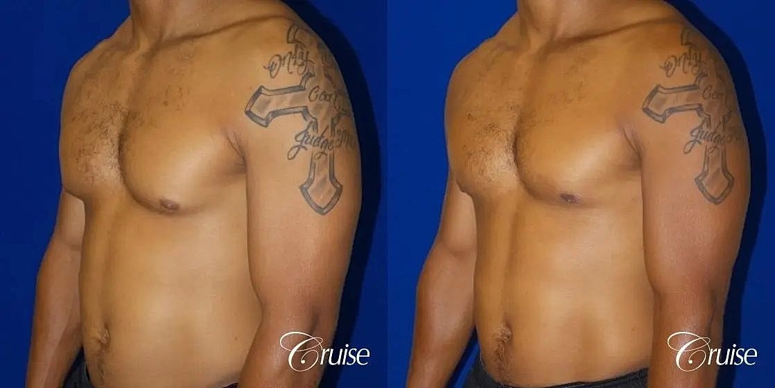 Gynecomastia Surgery Before & After