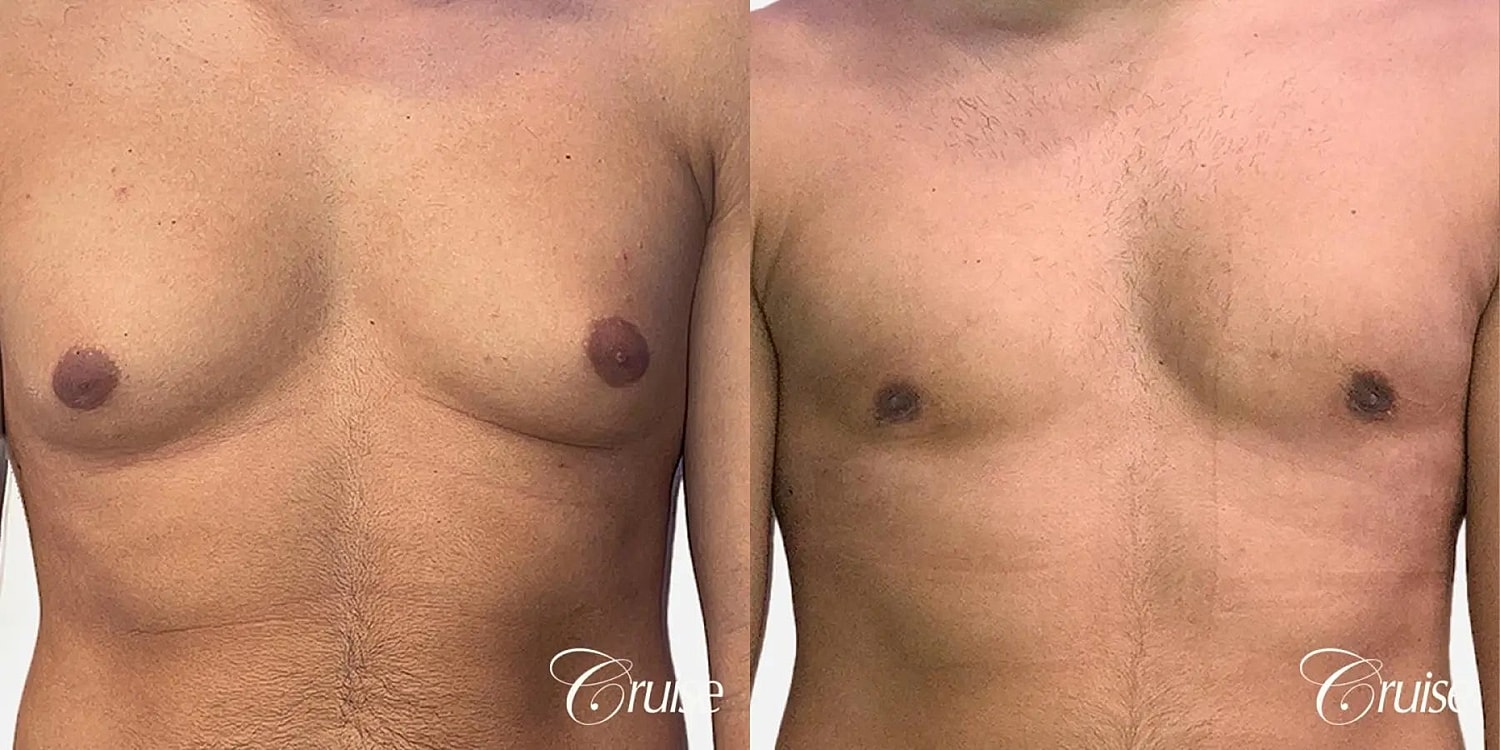 Gynecomastia Surgery Before & After