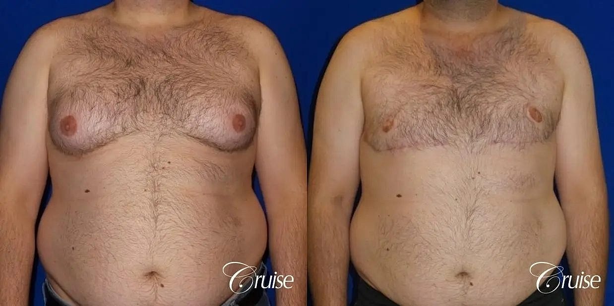 Gynecomastia Surgery Before & After