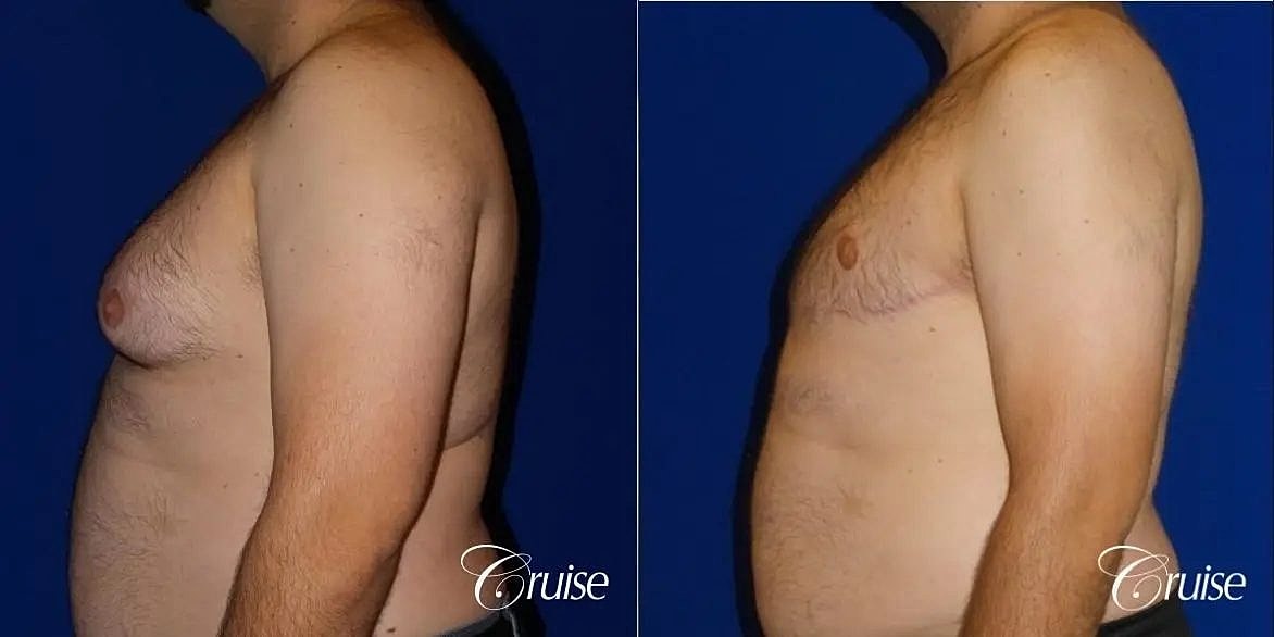 Gynecomastia Surgery Before & After