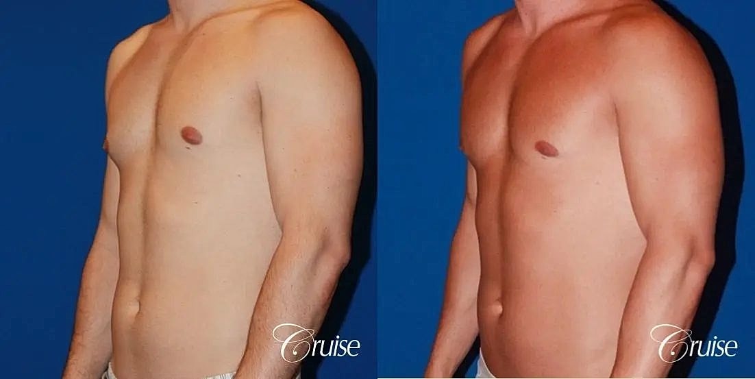 Gynecomastia Surgery Before & After