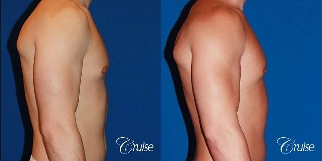 Gynecomastia Surgery Before & After