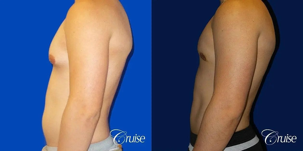 Gynecomastia Surgery Before & After