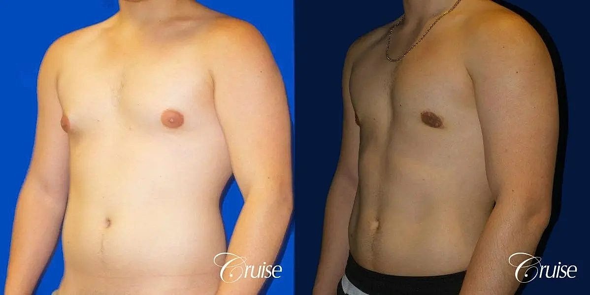 Gynecomastia Surgery Before & After