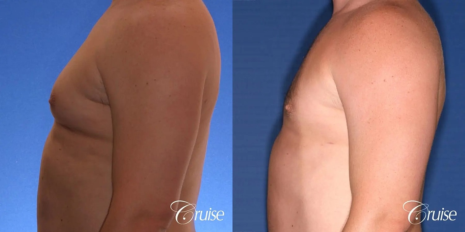 Gynecomastia Surgery Before & After